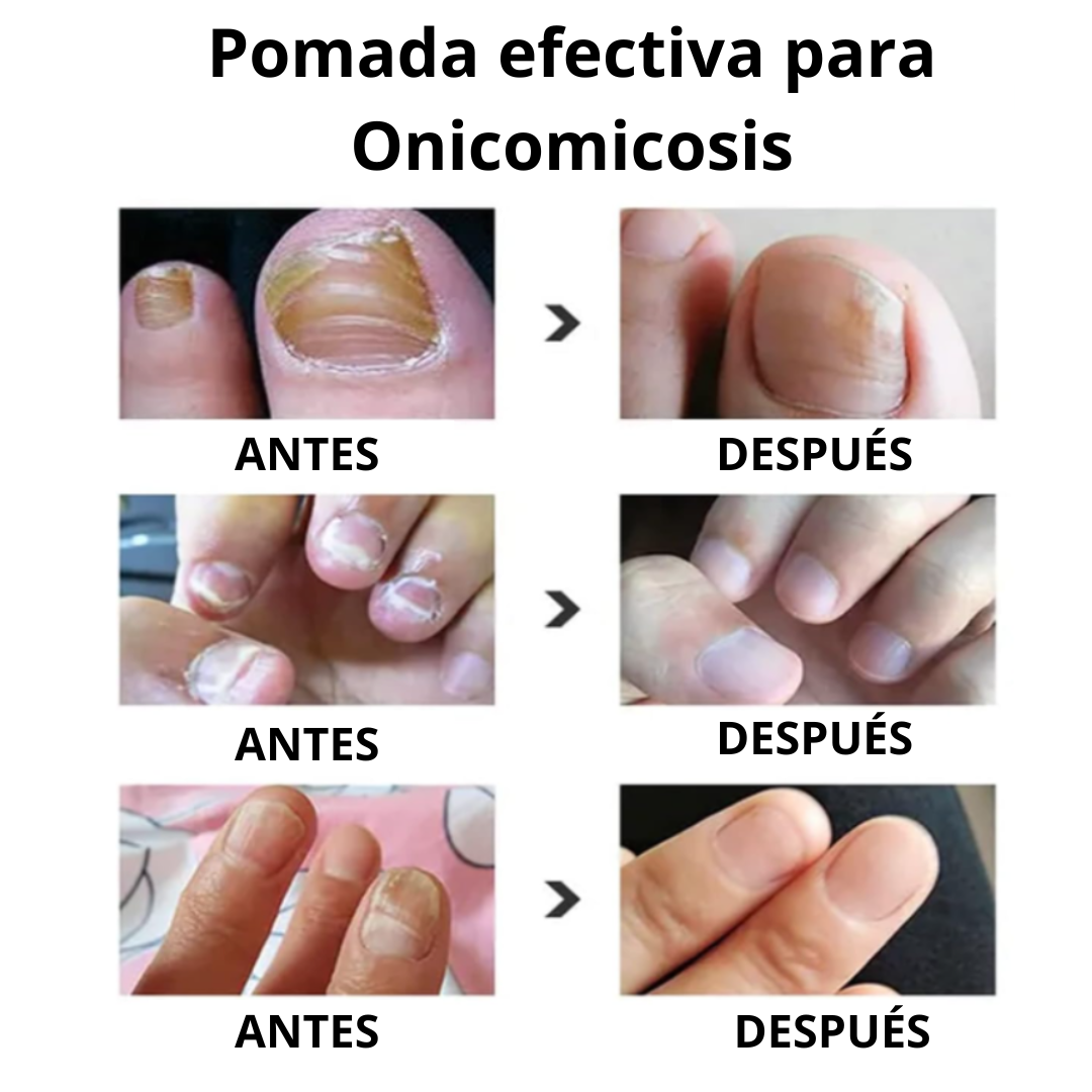 🧴 Nail Fungus® | Pomada para Uñas (Onicomicosis)