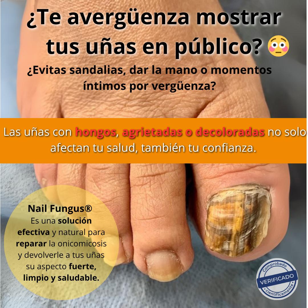 🧴 Nail Fungus® | Pomada para Uñas (Onicomicosis)