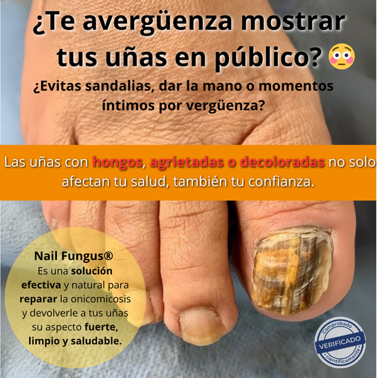 🧴 Nail Fungus® | Pomada para Uñas (Onicomicosis)