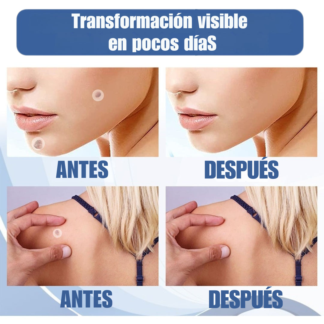 EELHOE PRO™   – Eliminación de Verrugas sin Dolor (144 Parches)